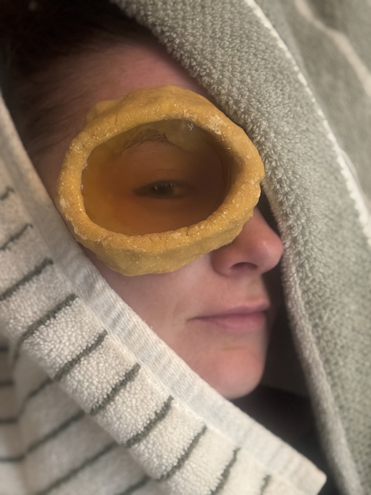 Netra Basti treatment at Om Maitri